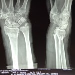Colle's Fracture Right wrist